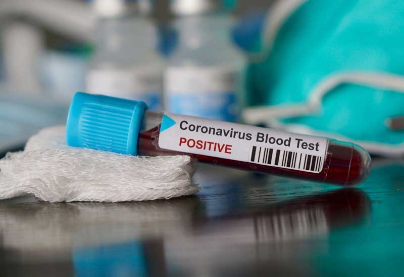 Azərbaycanda daha 4 nəfərdə koronavirus aşkarlandı